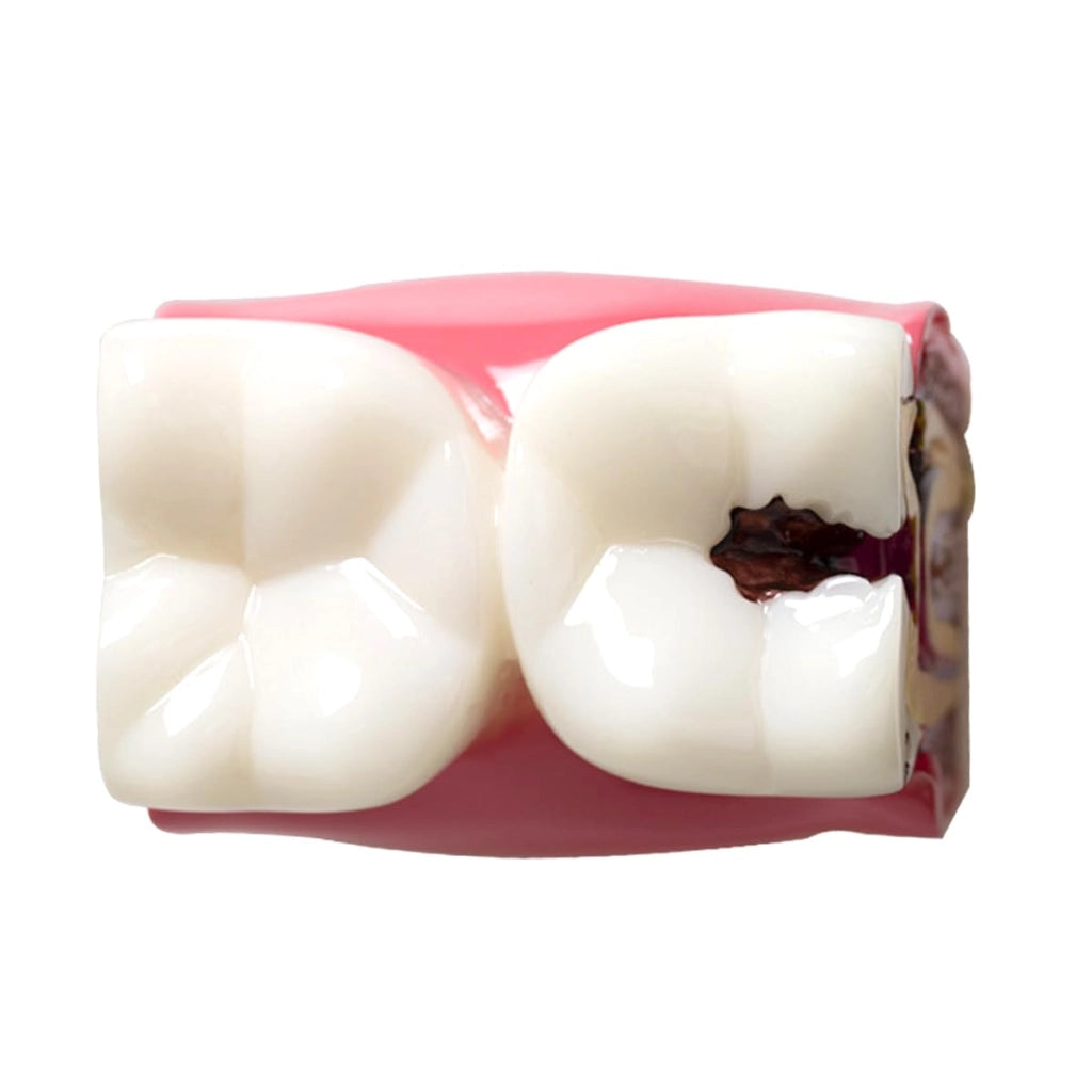 Modello per studi comparativi sulla carie, anatomia dentale, PVC, 5,5x8x8,5 cm